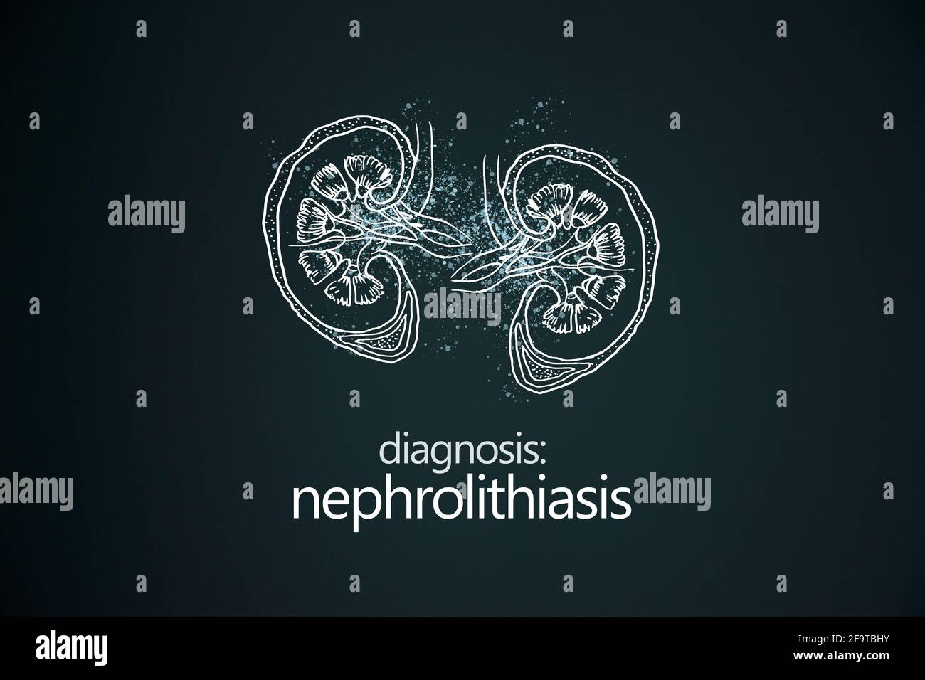 Néphrolithiase maladie des calculs rénaux ou urolithiase. Calculs rénaux ou pierres bloquant l'appareil urinaire.modèle de conception de style minimaliste Banque D'Images