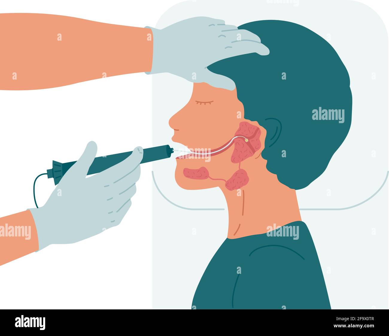 Chirurgie pour enlever une pierre du conduit de la glande salivaire parotide. Illustration de Vecteur