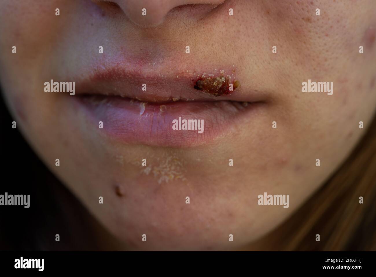 gros plan de la jeune femme avec de véritables plaies froides et sécher la peau Banque D'Images gros plan de la jeune femme avec de véritables plaies froides et sécher la peau Banque D'Images