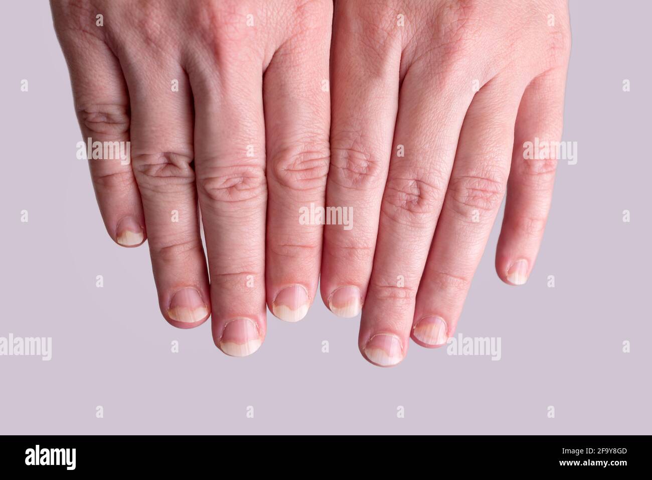 Infection Fongique Des Ongles Banque D Image Et Photos Alamy Infection Fongique Des Ongles Banque D Image Et Photos Alamy