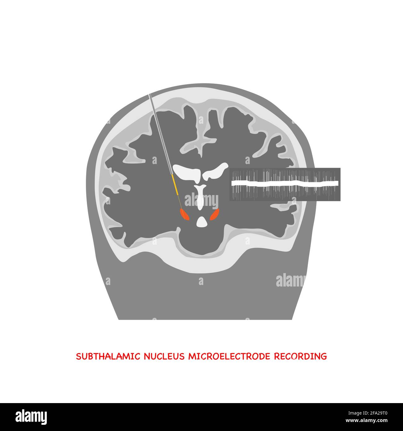 Vue coronale Illustration de l'enregistrement par microélectrode du cerveau humain dans le noyau subthalamique pour la chirurgie de la maladie de Parkinson et les ondes cérébrales. Illustration de Vecteur