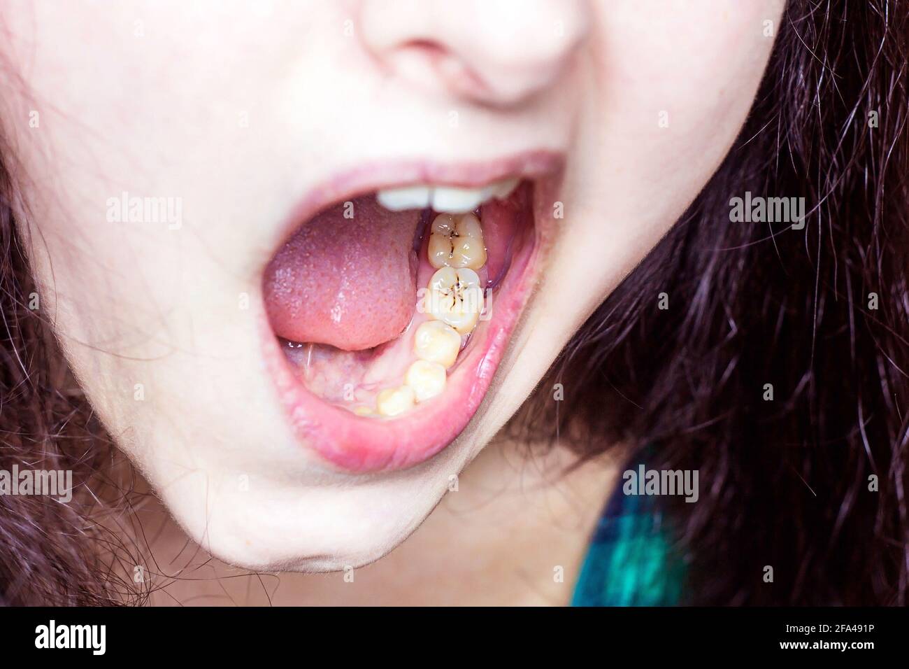 Jeune femme caucasienne bouche avec des dents malsaines gros plan. Caries dentaires, maux de dents, problèmes de dents concept. Banque D'Images