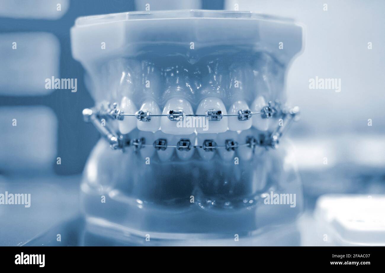 Accolades sur les dents artificielles mâchoires gros plan, dentisterie dentaire Banque D'Images