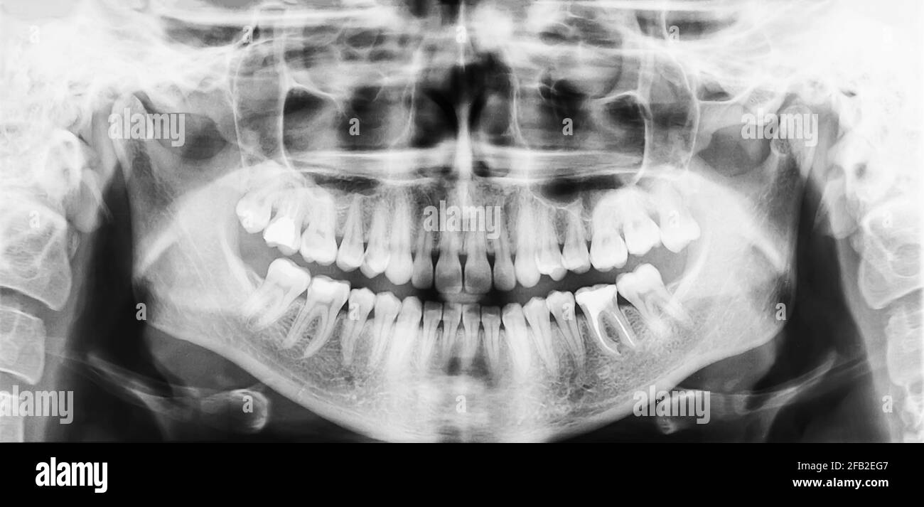 Radiographie dentaire panoramique de la cavité buccale avec les dents Banque D'Images