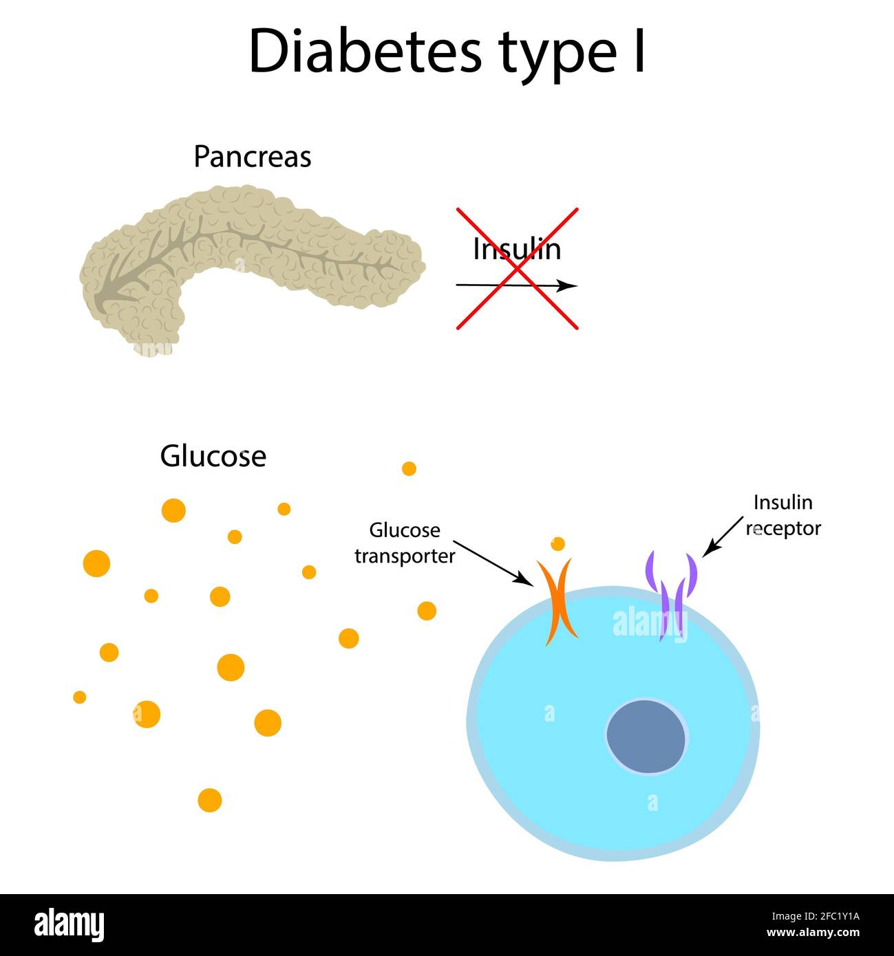 Diabète de type 1, illustration Banque D'Images