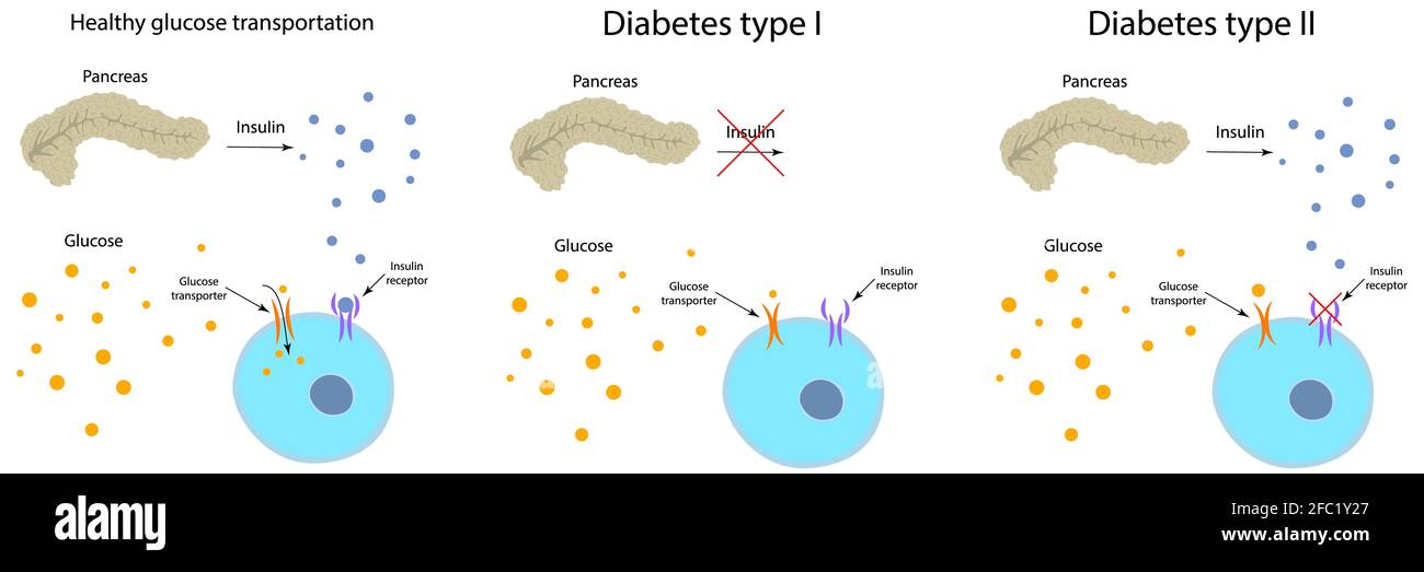 Diabète et métabolisme sain du glucose, illustration Banque D'Images