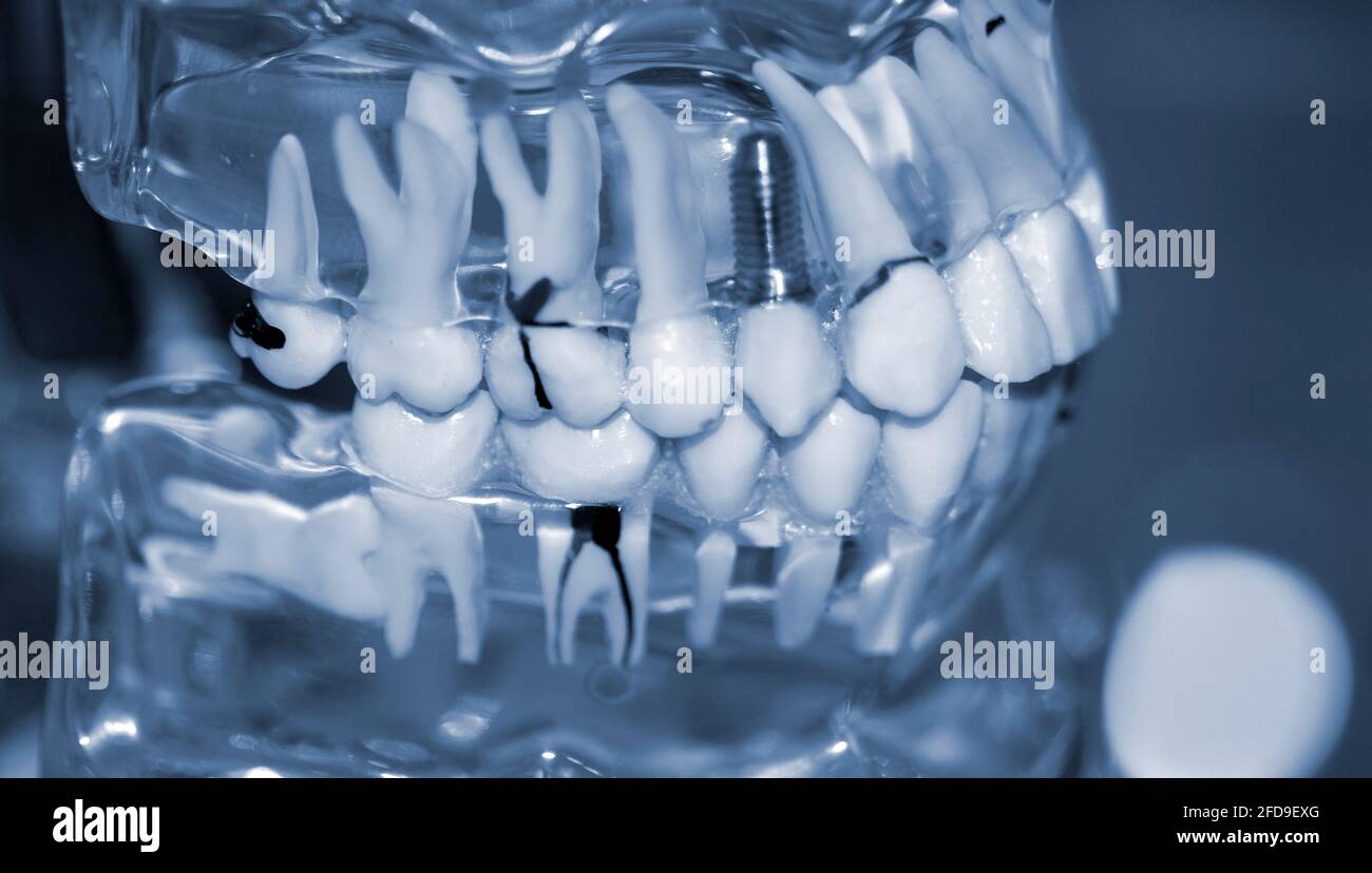 Modèle transparent de dents humaines avec implants en gros plan. Banque D'Images