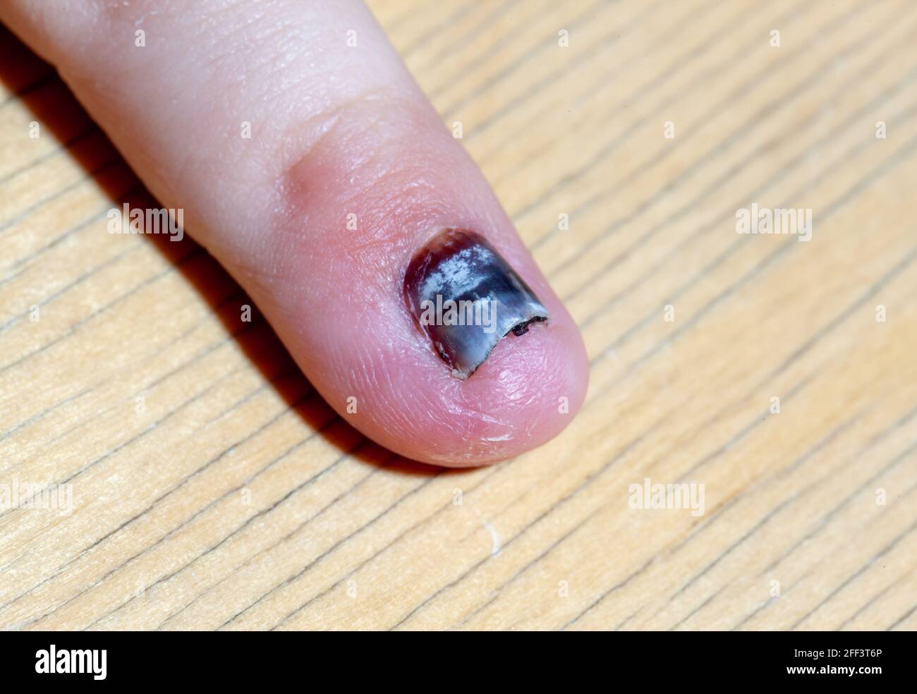 Hématome sur la main enfant Banque de photographies et d’images à haute résolution Alamy