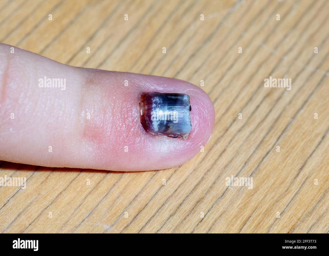 Le Petit Doigt Du Bebe Apres Un Coup Fort Un Hematome Forme Sous L Ongle Blessure Au Petit Doigt Photo Stock Alamy Le Petit Doigt Du Bebe Apres Un Coup Fort Un Hematome Forme Sous L Ongle Blessure Au Petit Doigt Photo Stock Alamy