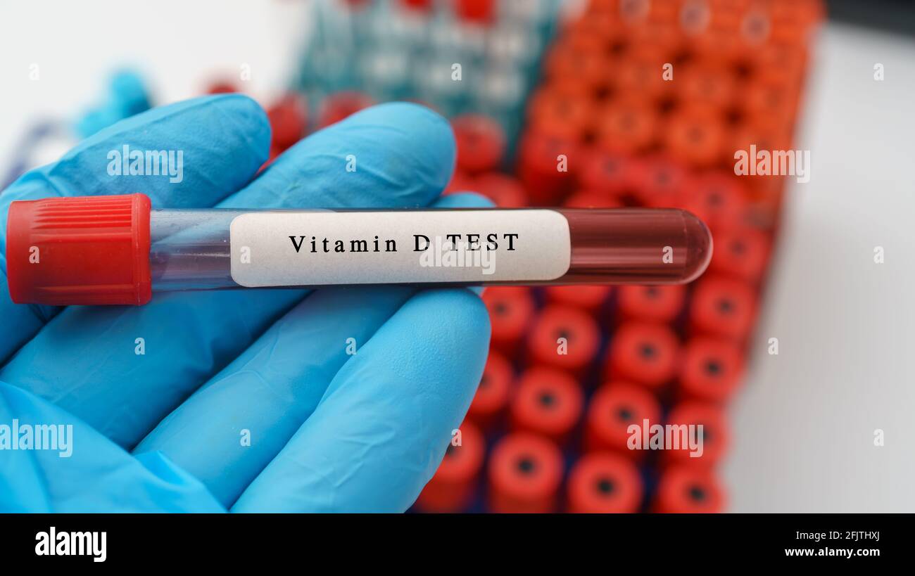 Résultat du test de vitamine D avec un échantillon de sang dans une éprouvette sur la main du médecin dans le laboratoire médical Banque D'Images