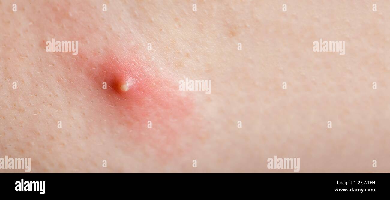 bouton purulent sur la peau humaine enflammée gros plan, la santé du corps  de l'adolescence et les problèmes Photo Stock - Alamy