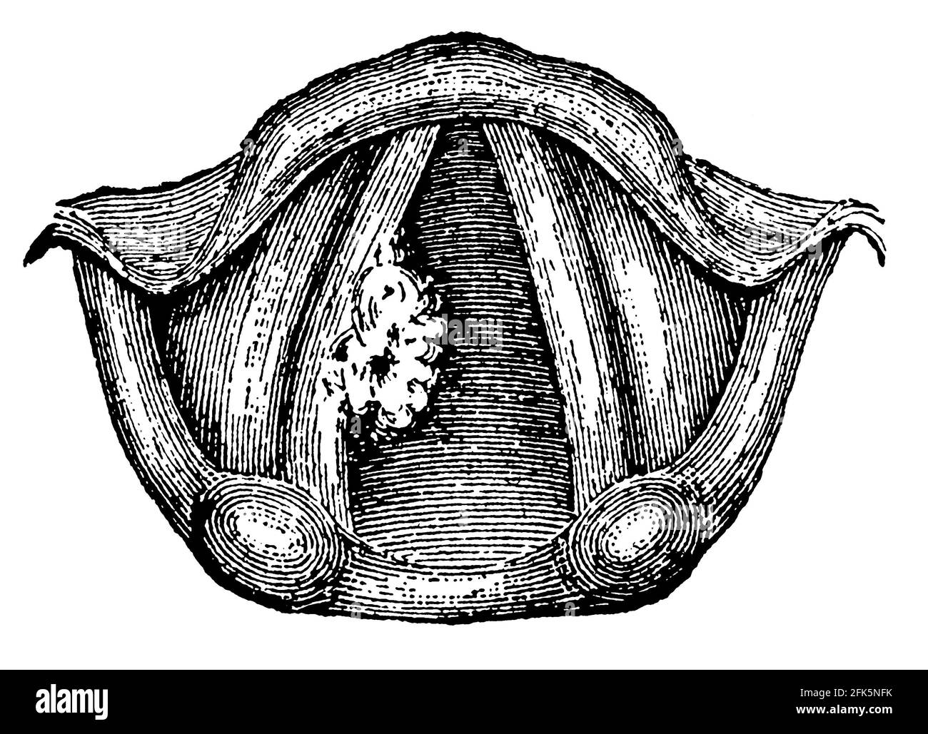 Ulcère dans le larynx. Illustration du 19e siècle. Allemagne. Arrière-plan blanc. Banque D'Images