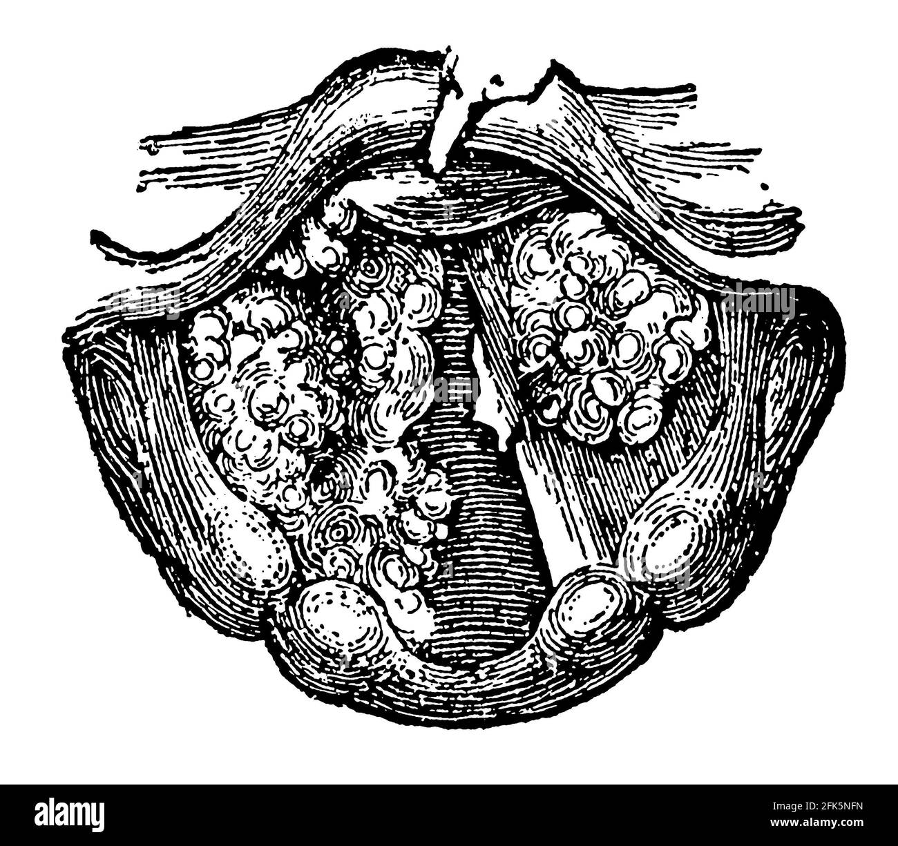 Ulcère dans le larynx. Illustration du 19e siècle. Allemagne. Arrière-plan blanc. Banque D'Images