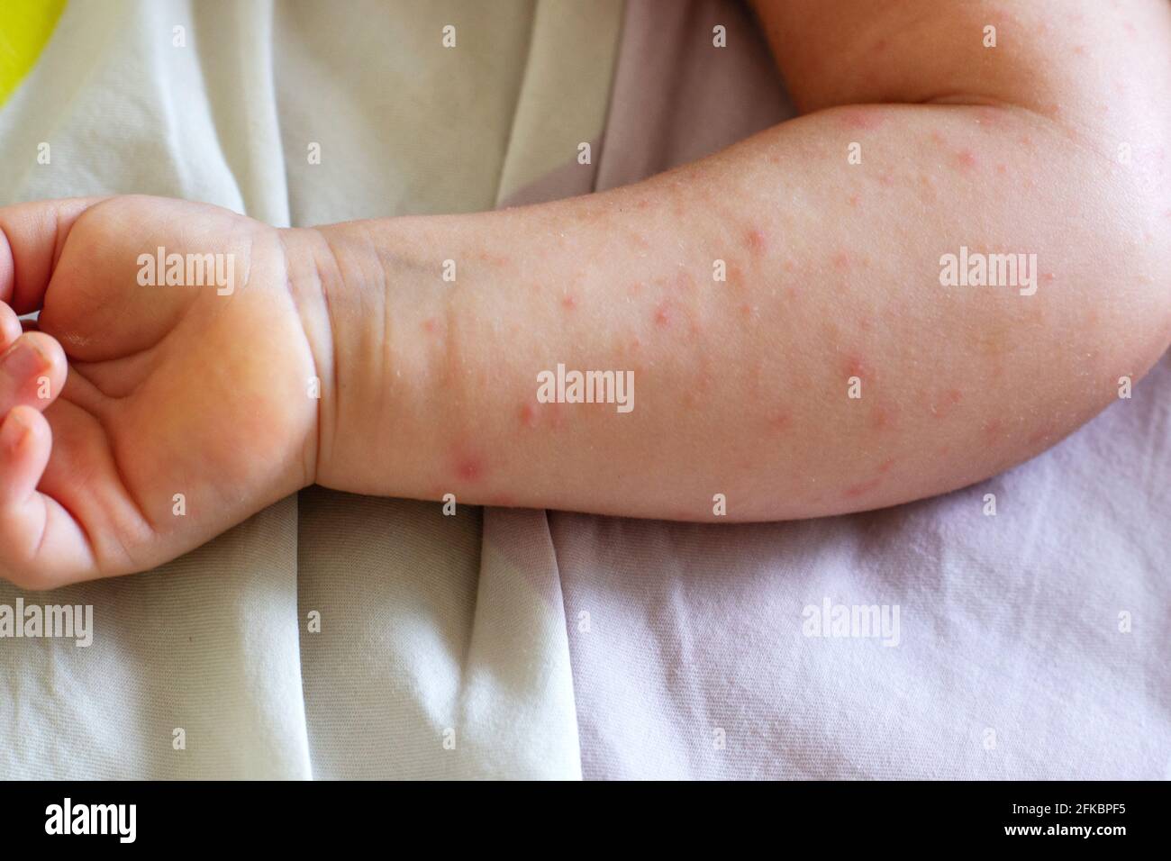 Atopic dermatitis child Banque de photographies et d'images à ...