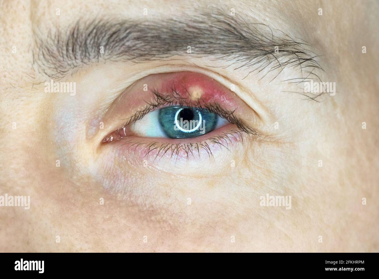 Chalazion Banque D Image Et Photos Alamy