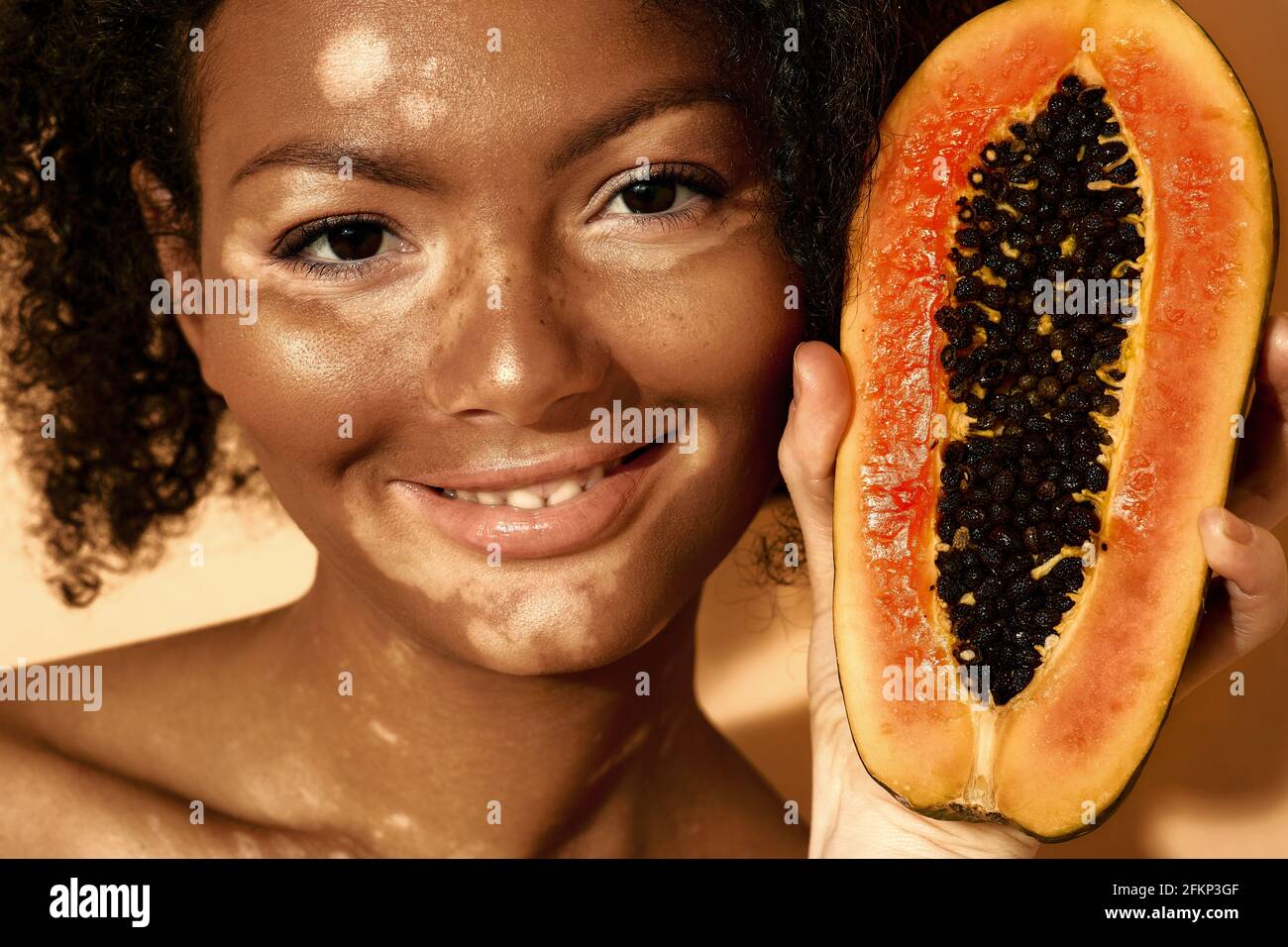 Portrait d'une femme afro-américaine avec le vitiligo et la papaye près de son visage, gros plan. Hydratant et prenant soin de problèmes de peau pigmentée Banque D'Images