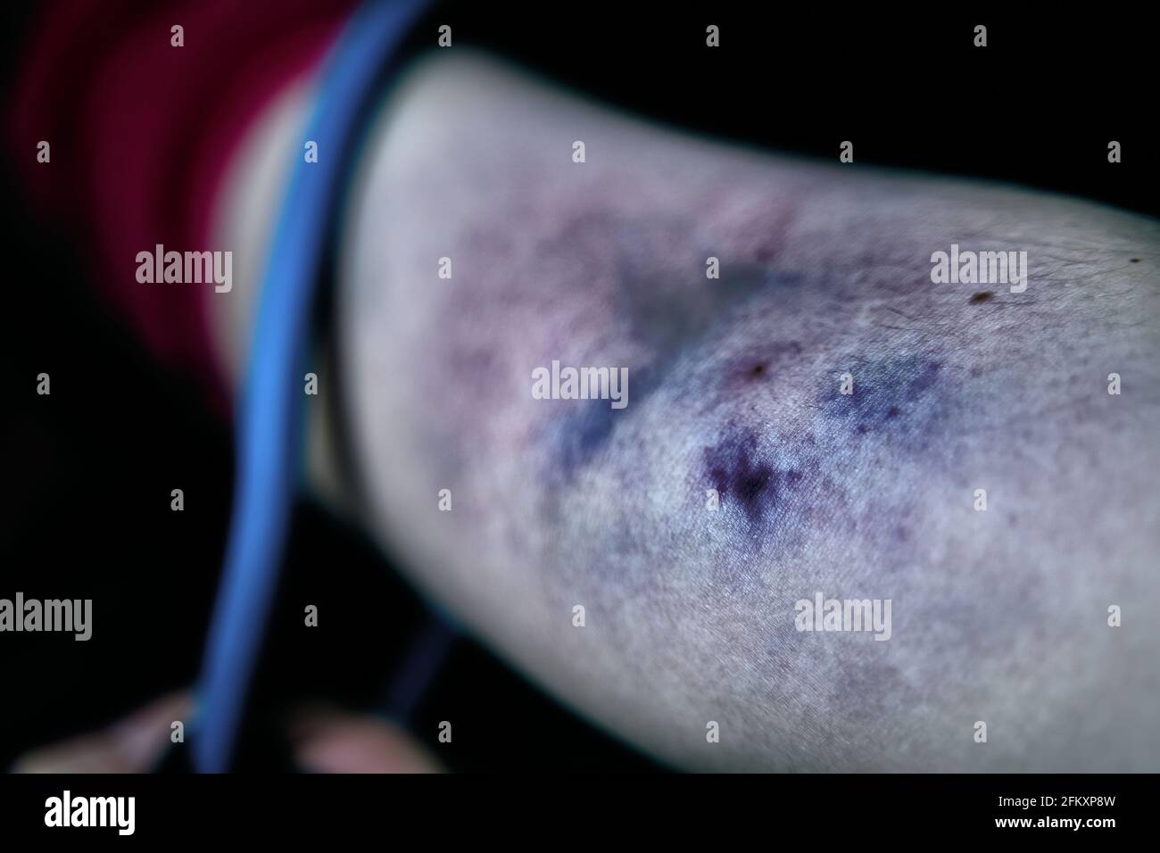 Gros plan sur l'hématome sanguin. Le bras de la femme est meurtri par la prise de narcotiques intraveineux. Le drogué tire le tourniquet sur le bras. Concept de désespoir et de dépression. Dépendance à des substances illégales. Banque D'Images