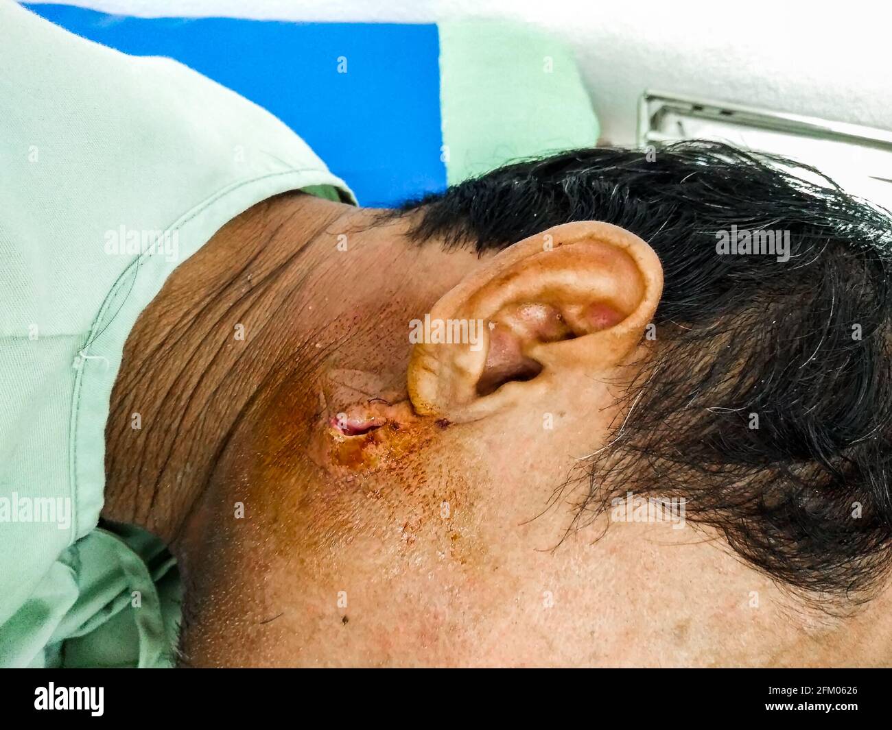 Gros plan de l'abcès sur la face droite derrière l'oreille de homme Photo  Stock - Alamy