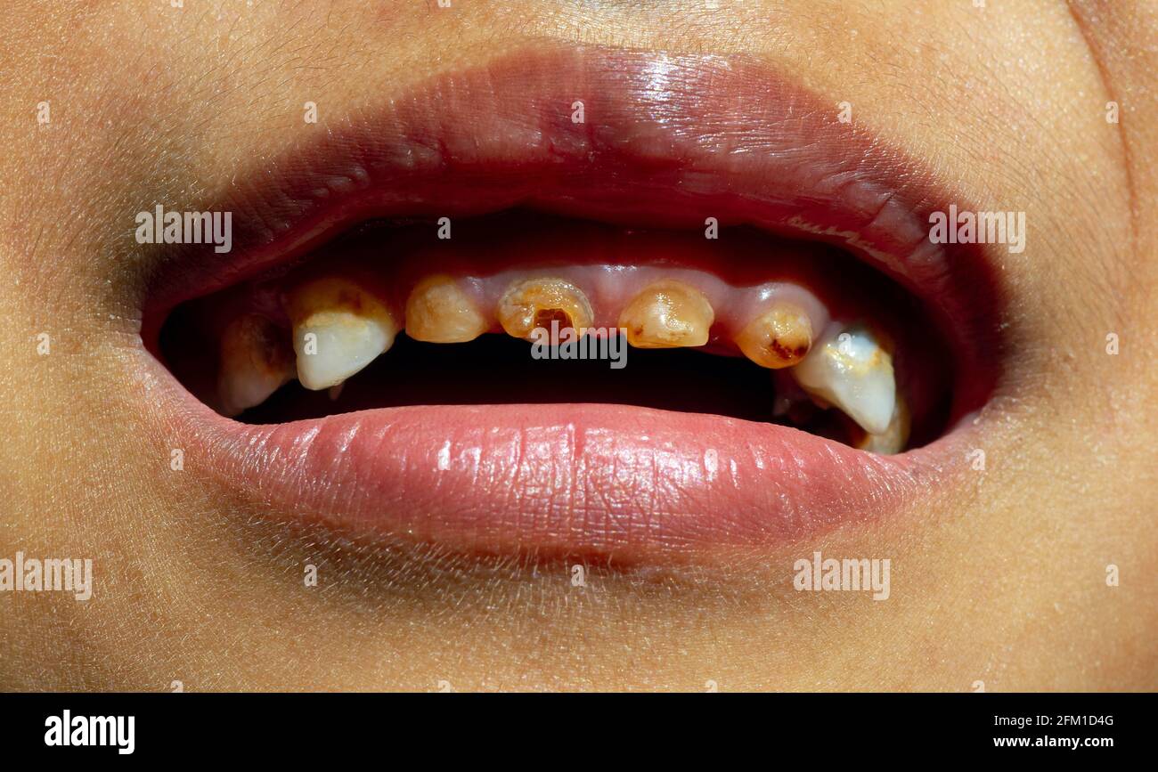 Caries dentaires sur un enfant, dans les dents avant. Concept de soins dentaires Banque D'Images