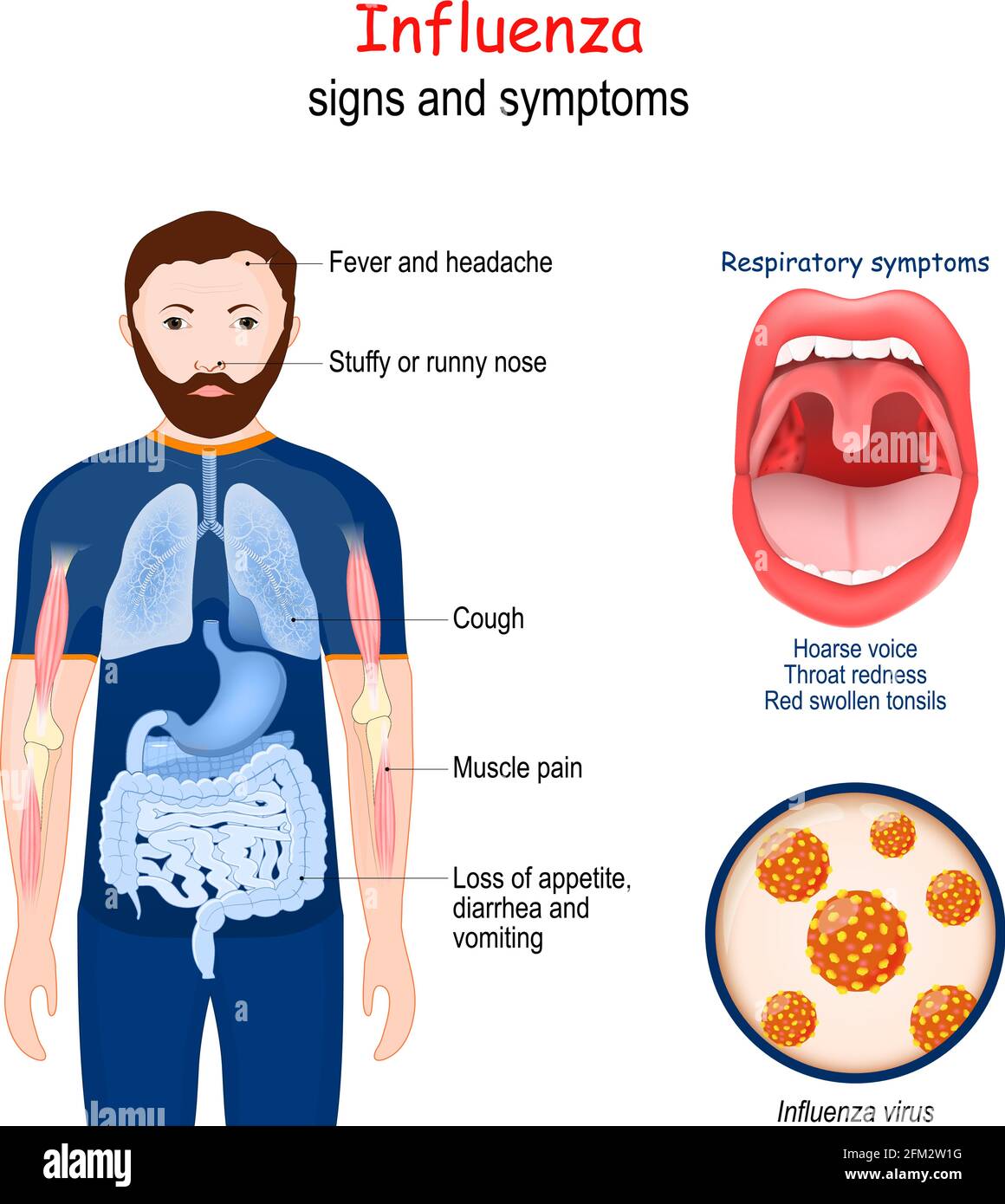 La grippe. Signes et symptômes de maladies infectieuses. Grossissement des virus de la grippe. Gros plan de la bouche humaine avec des amygdales rouges et gonflées Illustration de Vecteur