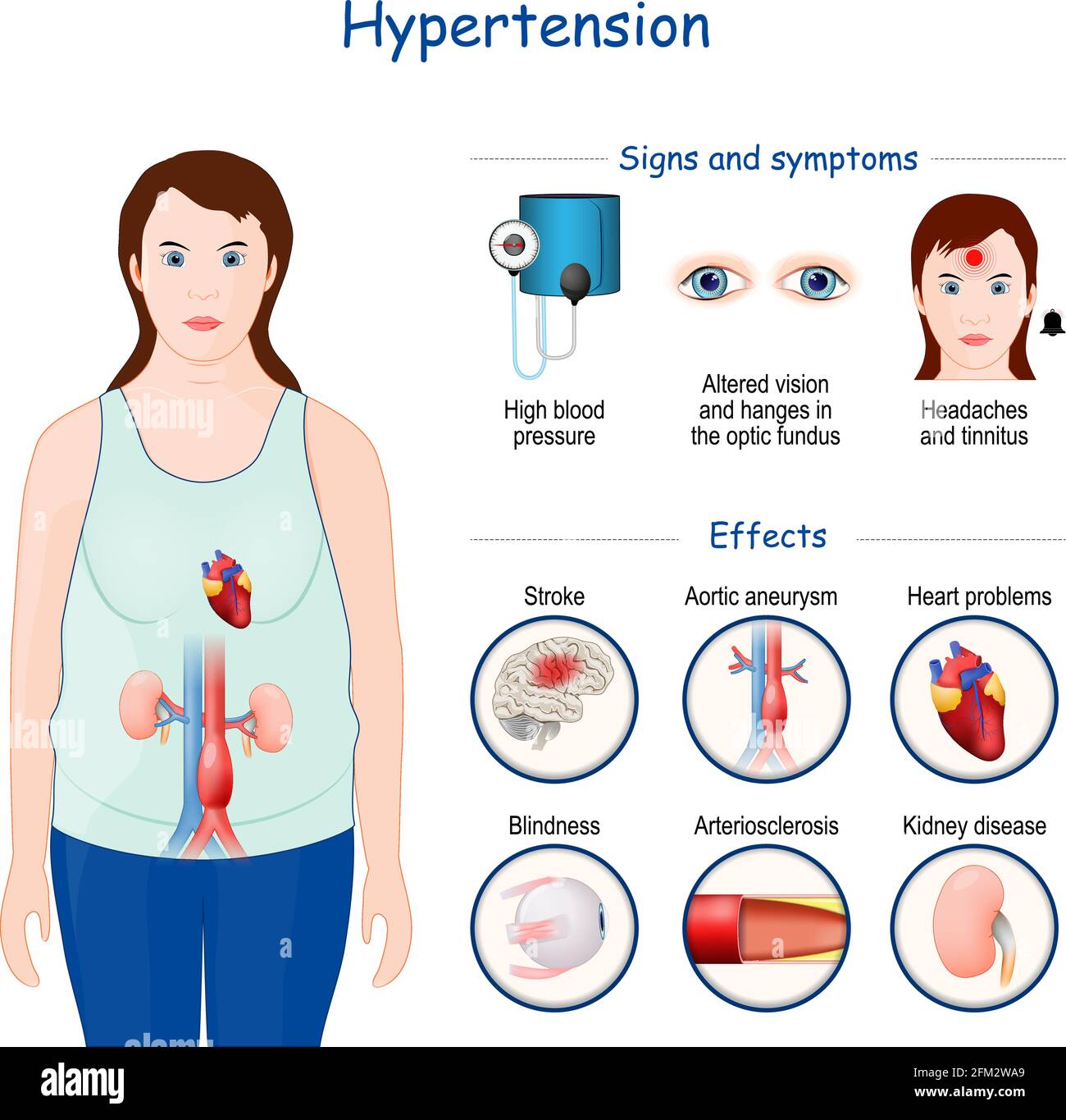 Hypertension. Signes, symptômes et effets de l'hypertension artérielle. Illustration vectorielle. Infographie Illustration de Vecteur