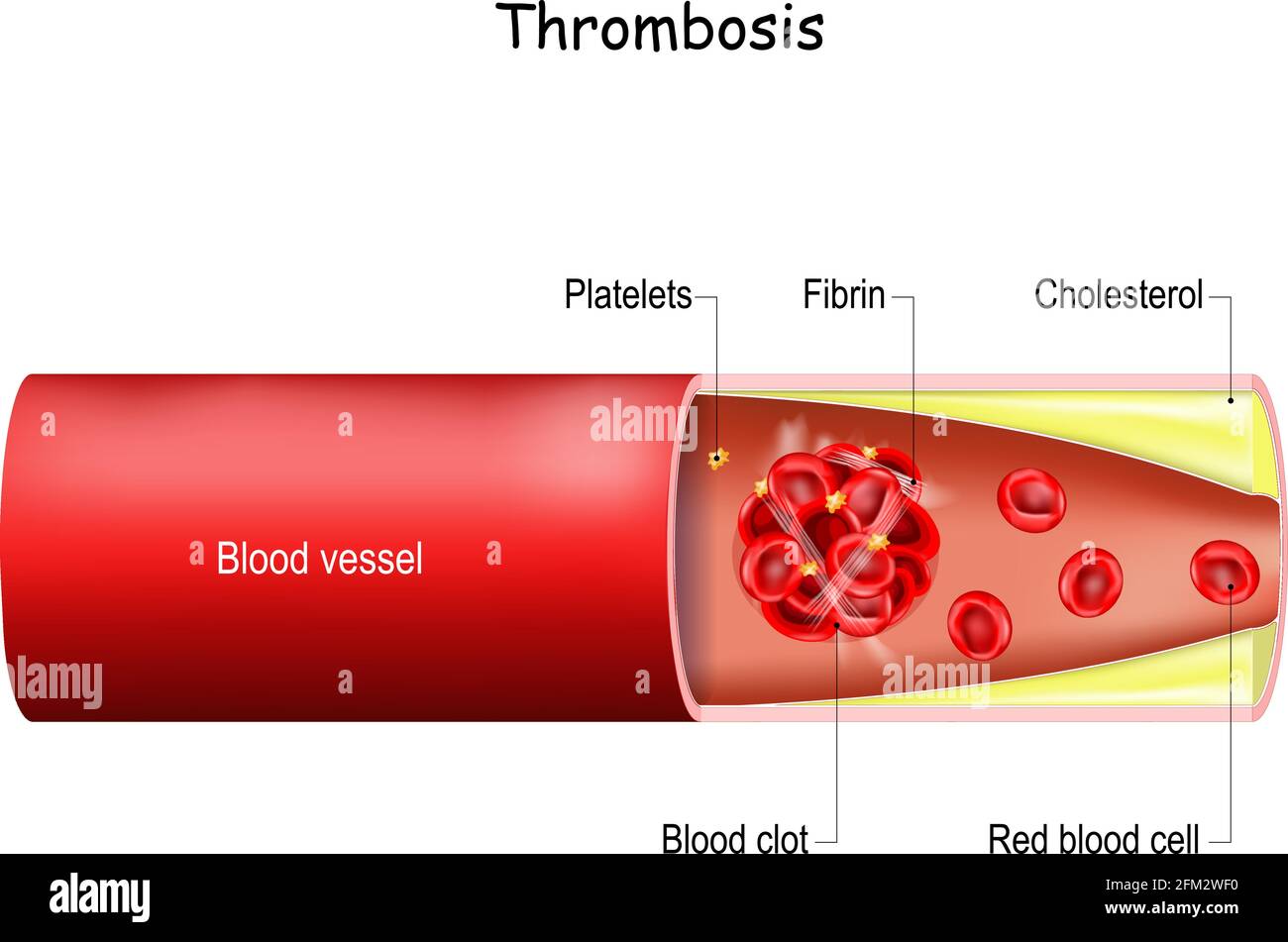 Thrombose. Caillot de sang dans un vaisseau sanguin (artère ou veine). Problème de santé. Illustration vectorielle à usage médical. Illustration de Vecteur