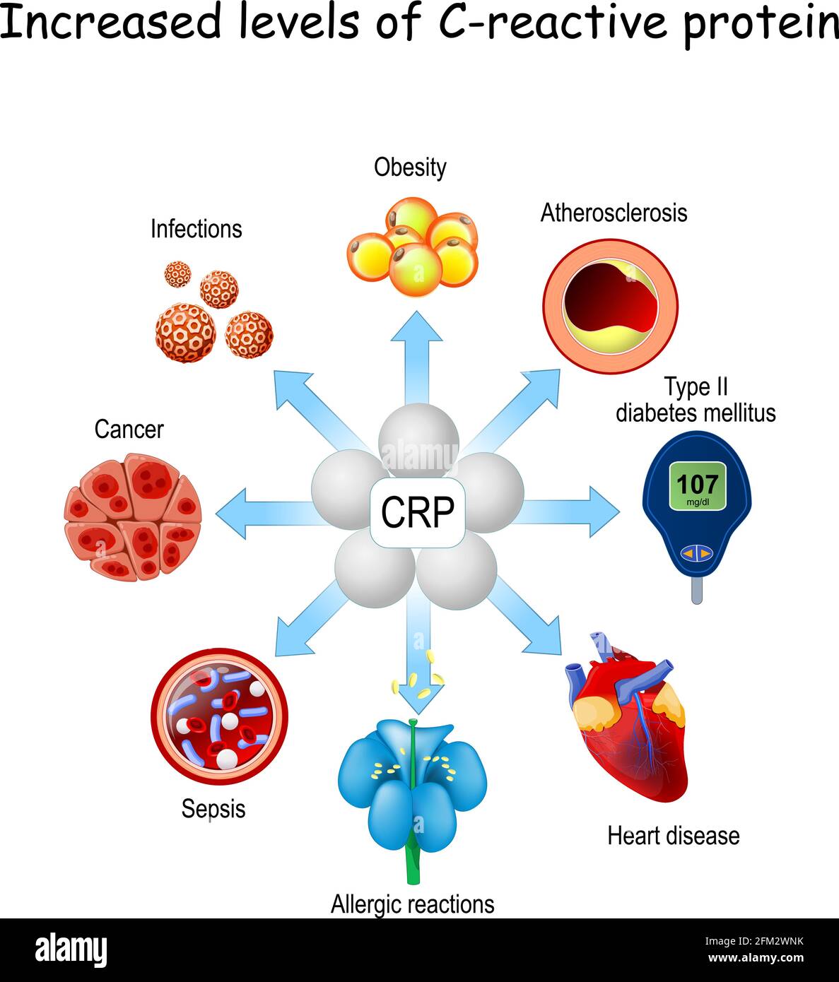 La CRP est un biomarqueur de l'inflammation et de l'infection. Augmentation des taux de protéine C-réactive et risque de développer différentes maladies du diabète, allergique Illustration de Vecteur