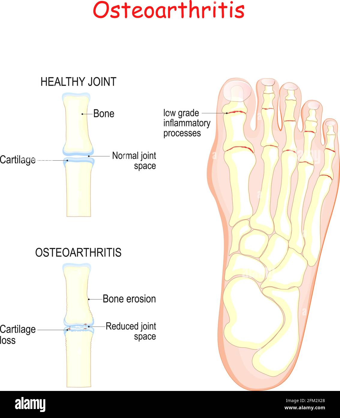 Arthrose. Comparaison articulation saine et inflammation articulation avec érosion osseuse et perte de cartilage. Pied humain. Illustration vectorielle Illustration de Vecteur