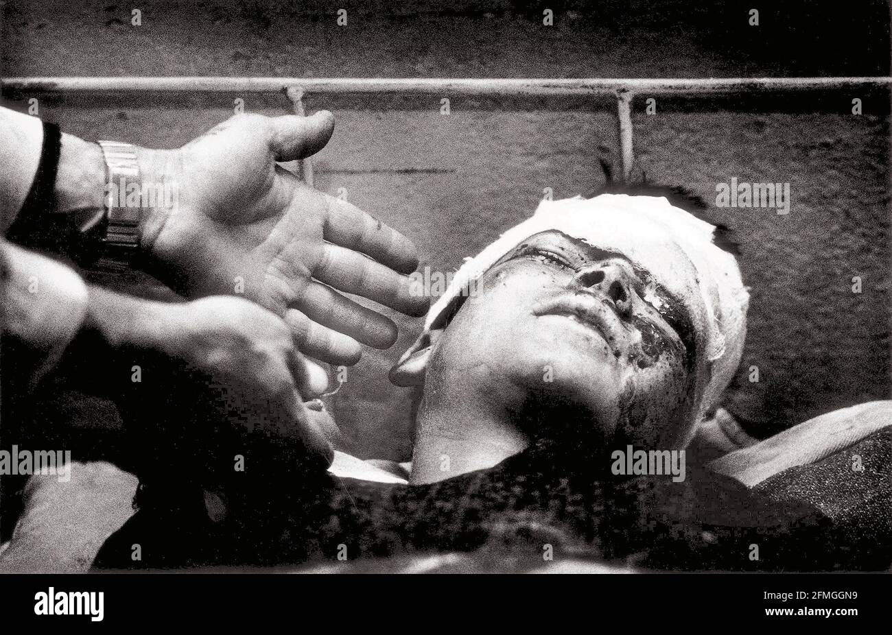 Une jeune mine victime du conflit afghan entre les Soviétiques Les envahisseurs et les combattants de la liberté Mujahidin se trouvent à l'hôpital près de Kaboul DBase Banque D'Images