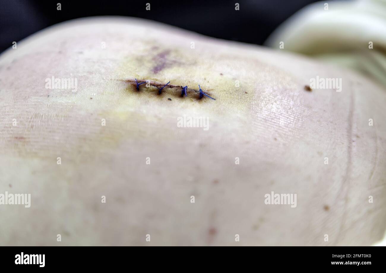 Détail de l'opération médicale, points de suture pour la guérison, post-opératoire Banque D'Images