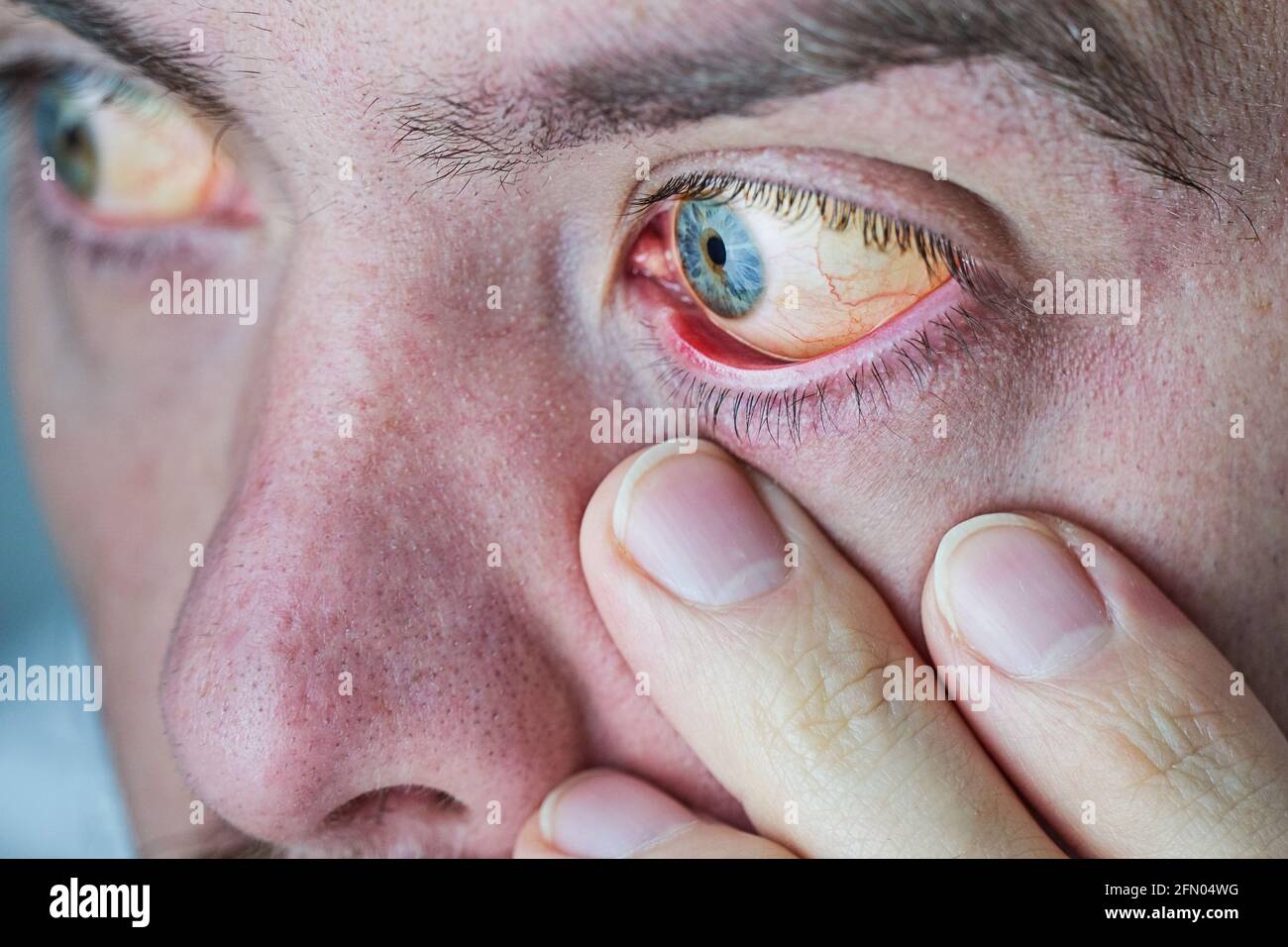 Infection Oculaire Banque D Image Et Photos Alamy Infection Oculaire Banque D Image Et Photos Alamy
