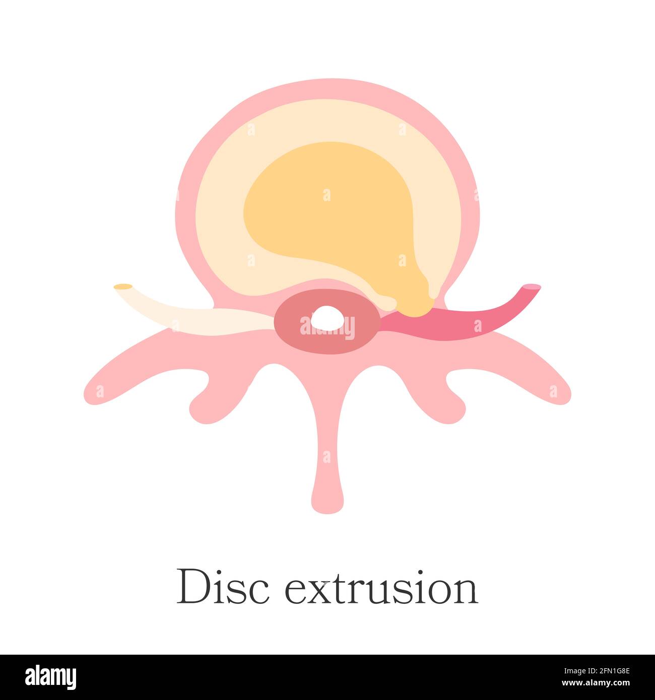 Colonne vertébrale herniée - Extrusion, rupture complète. Diagramme vectoriel, tracé à la main. Infographie sur la hernie de troisième étape du disque intervertébral Illustration de Vecteur