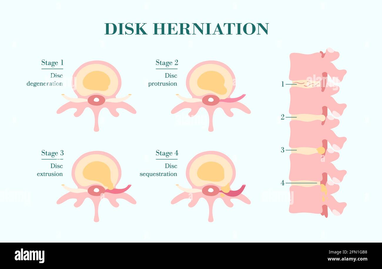 protrusion-herniaire-foraminale-vcog