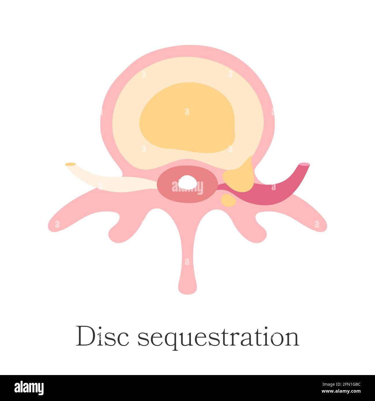 Colonne vertébrale herniée - séquestration, libération de liquide de noyau. Diagramme vectoriel, tracé à la main. Infographie sur la hernie de troisième étape du disque intervertébral Illustration de Vecteur