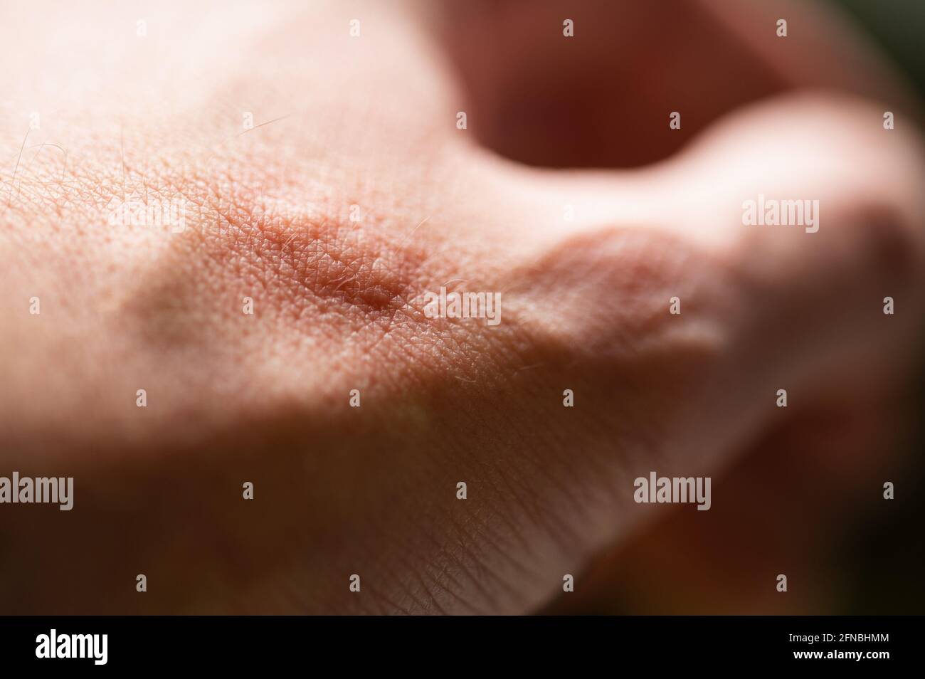 Éruption allergique après contact allergie: Pustules, taches, cloques et wheals sur la peau comme réaction allergique Banque D'Images Éruption allergique après contact allergie: Pustules, taches, cloques et wheals sur la peau comme réaction allergique Banque D'Images