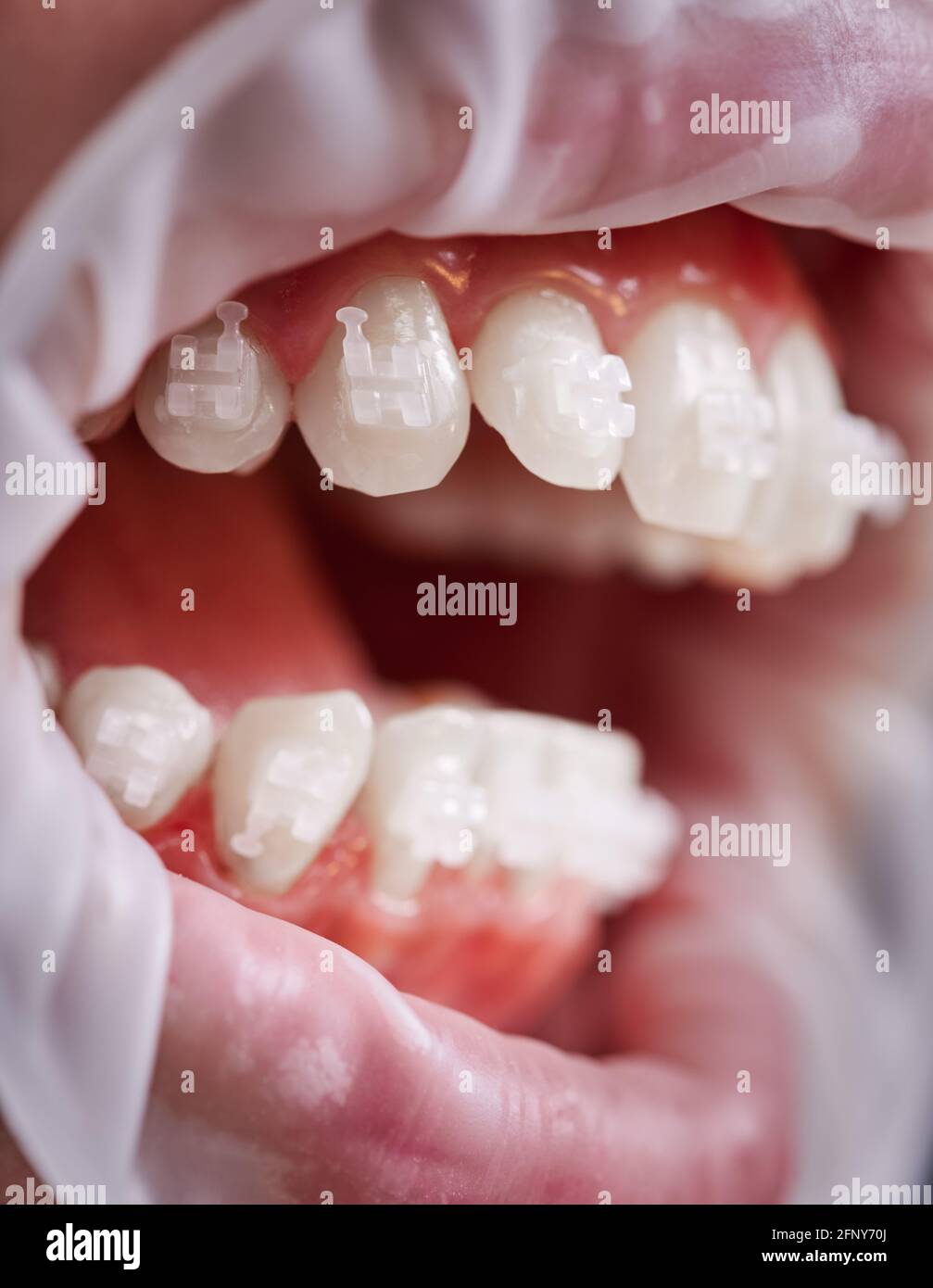 Gros plan d'une personne à la bouche ouverte et aux dents blanches avec des appareils orthodontiques. Patient avec un rétracteur de joue dans la bouche ayant une procédure dentaire en clinique. Concept de la dentisterie et de l'orthodontie Banque D'Images Gros plan d'une personne à la bouche ouverte et aux dents blanches avec des appareils orthodontiques. Patient avec un rétracteur de joue dans la bouche ayant une procédure dentaire en clinique. Concept de la dentisterie et de l'orthodontie Banque D'Images