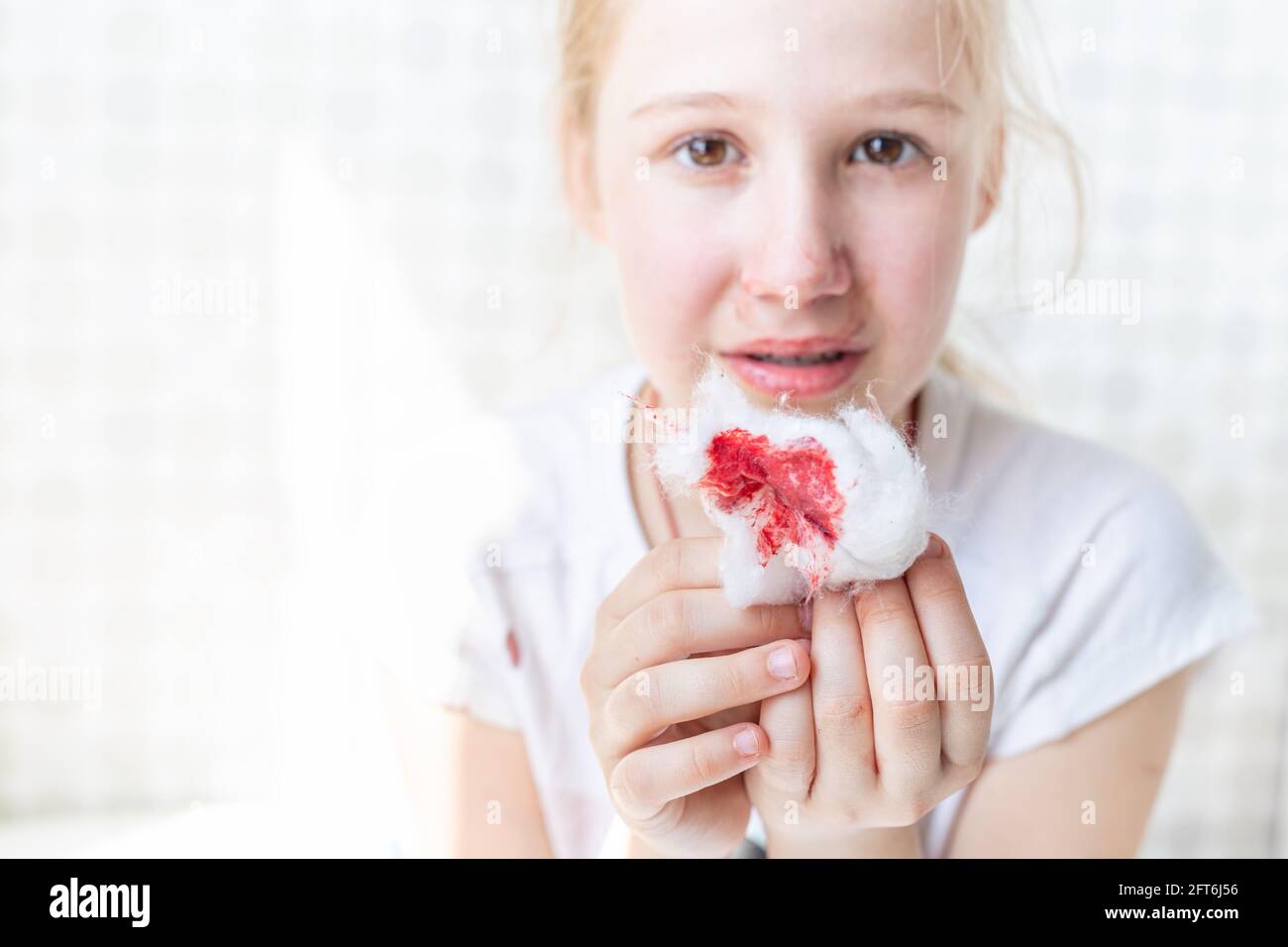 La laine de coton sanglante dans les mains d'un enfant. Épistaxis, symptôme de la maladie, traumatisme. Banque D'Images