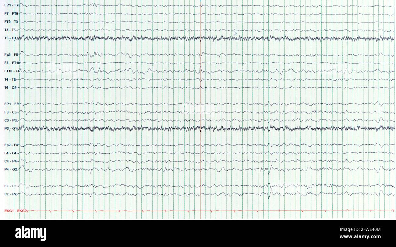 Photographie de l'électroencéphalograhie humaine d'un patient épileptique présentant une onde aiguë lors de l'absence de crise ou de l'EEG interictal. Banque D'Images