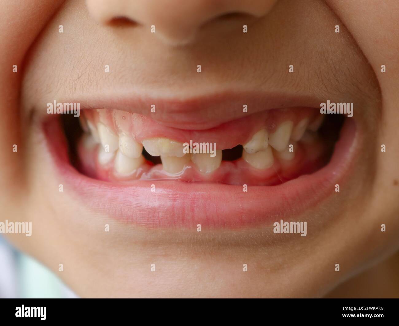 Enfant aux dents cassées, espace dans les dents Banque D'Images