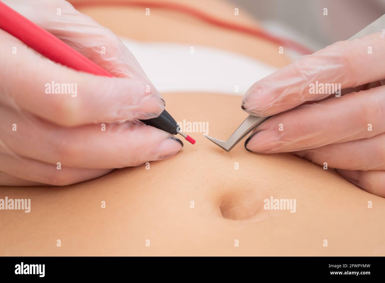 Femme en épilation électrique sur son ventre. Retrait matériel permanent  des poils abdominaux indésirables Photo Stock - Alamy