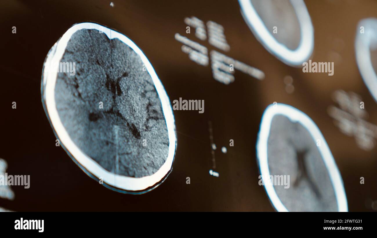 Rayons X du cerveau avec une blessure à la tête, maladie d'accident vasculaire cérébral chez le chegovik âgé. Imagerie par résonance magnétique, IRM en gros plan sur examen à l'hôpital par un médecin Banque D'Images