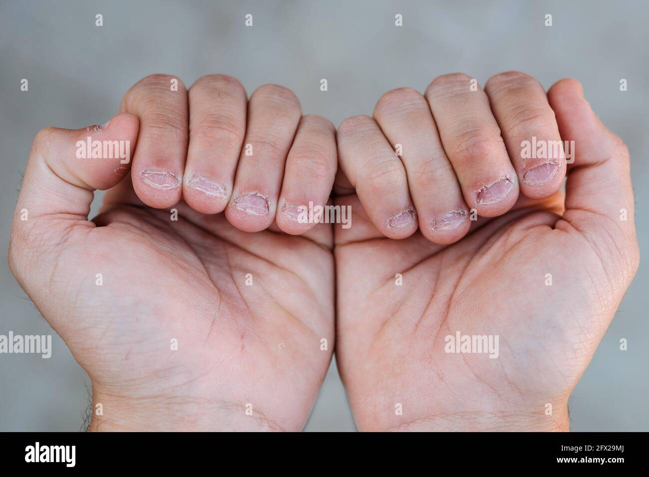 Gros plan sur deux mains avec mordu et laid ongles Banque D'Images