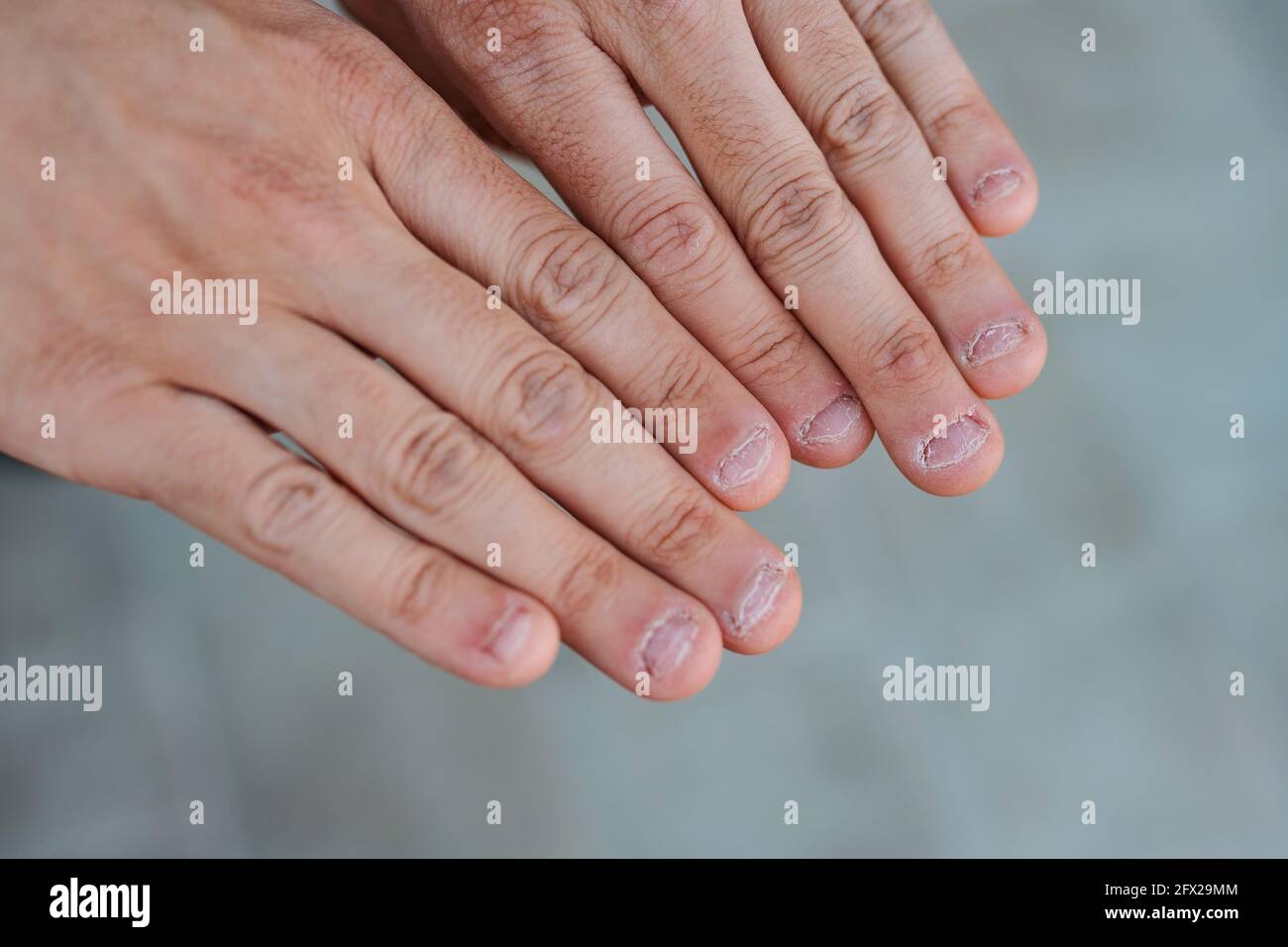 Gros plan sur deux mains avec mordu et laid ongles Banque D'Images