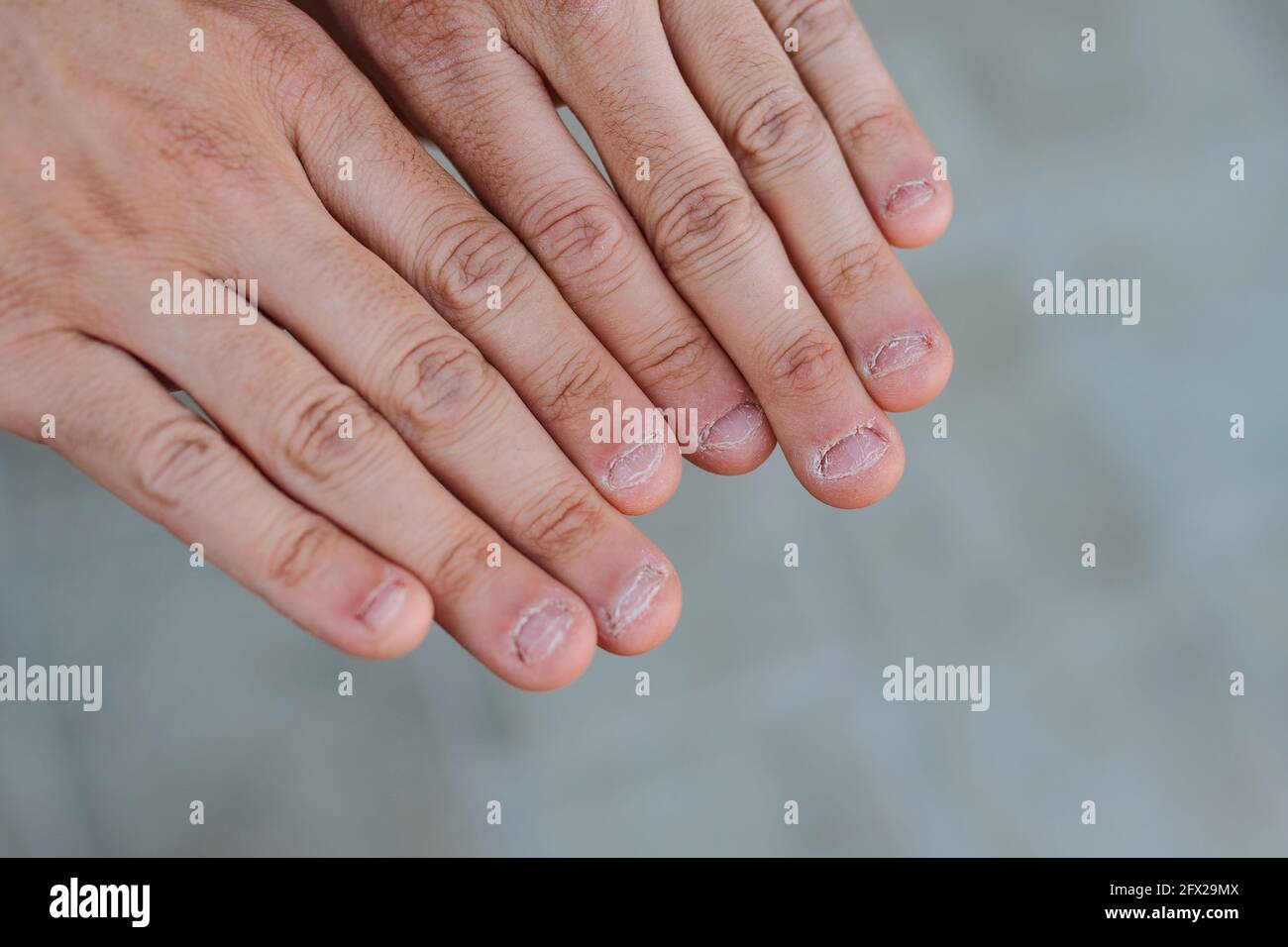 Gros plan sur deux mains avec mordu et laid ongles Photo Stock - Alamy