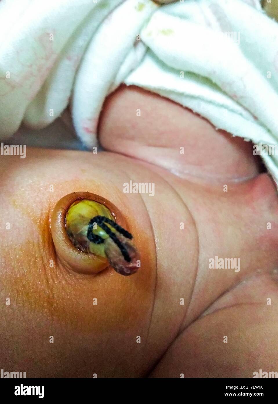 Gros Plan De La Plaie Infectee Du Cordon Ombilical Apres La Naissance 10 Jour Du Nouveau Ne Foyer Selectif Photo Stock Alamy