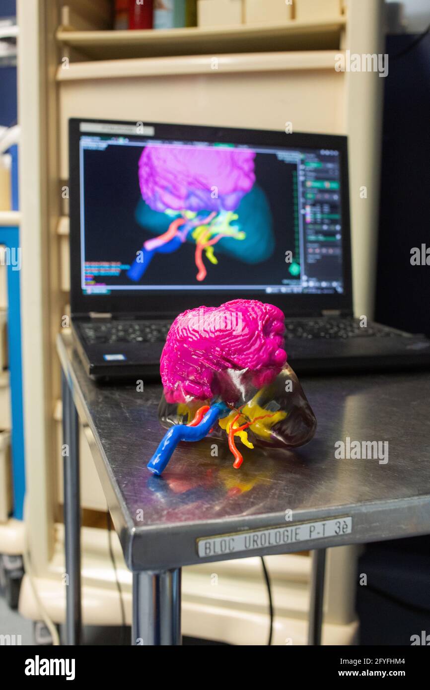 impression 3d d'un rein. La chirurgie rénale conservatrice robotique guidée par l'image assistée par la modélisation 3D, cette modélisation 3D du rein avec sa tumeur située i Banque D'Images