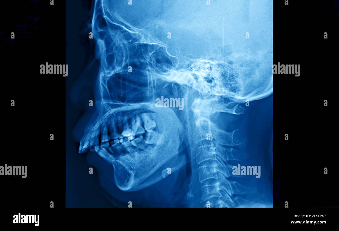 Film radiographique du crâne et du rachis cervical vue latérale, film  radiographique des os humains du nez à la poitrine Photo Stock - Alamy