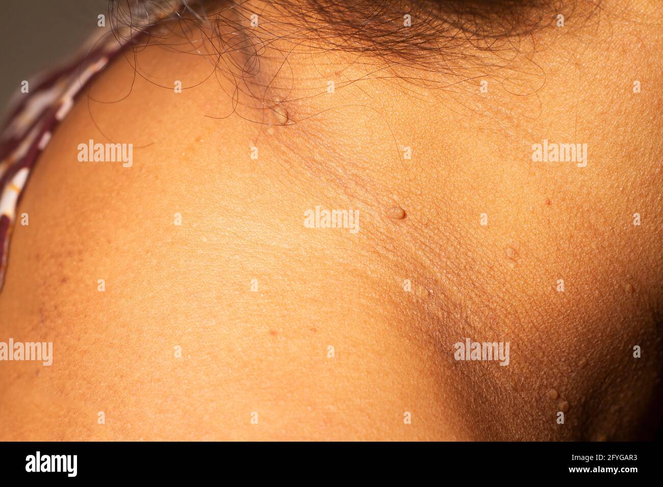 Gros plan sur la peau de la femme cou.gros plan de la verrue. Banque D'Images