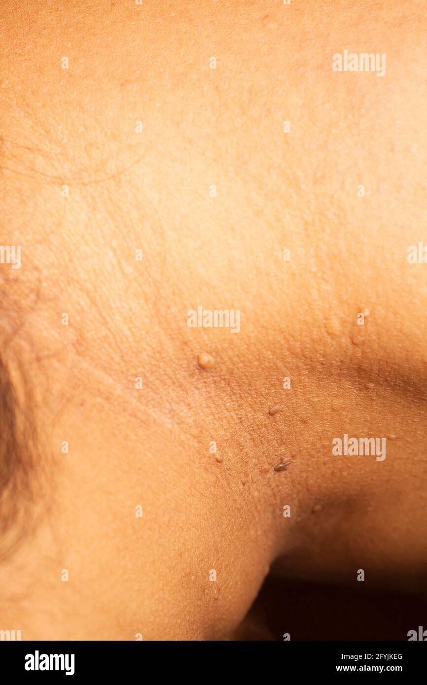 Gros plan sur la peau de la femme cou.gros plan de la verrue. Banque D'Images