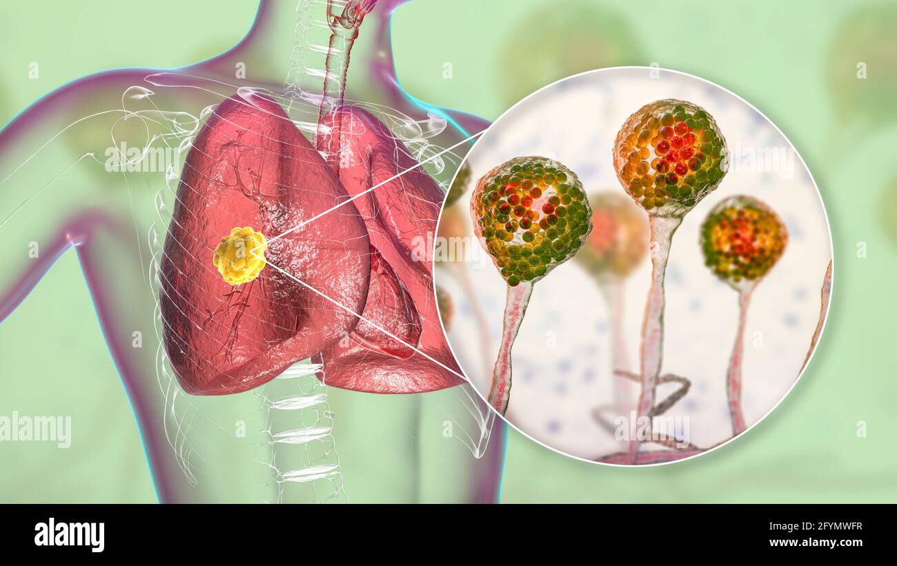 Mucormycose pulmonaire, illustration Banque D'Images